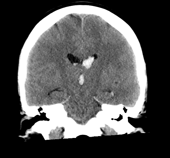 File:Arteriovenous malformation (cerebral) (Radiopaedia 40070-42579 Coronal non-contrast 21).png