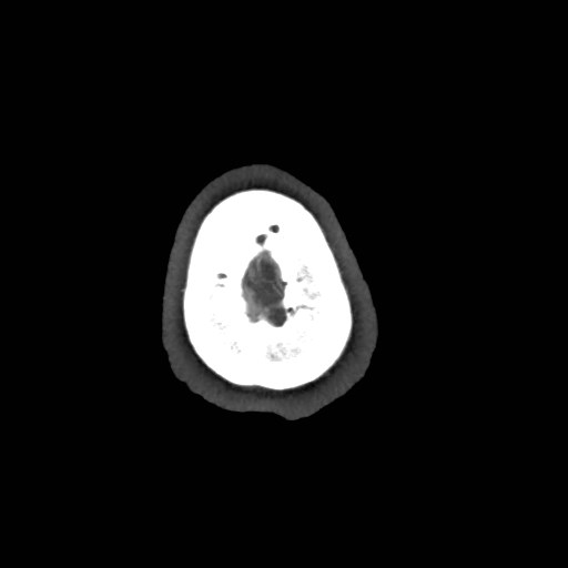 Artery of Percheron infarct (Radiopaedia 48088-52894 A 172).jpg