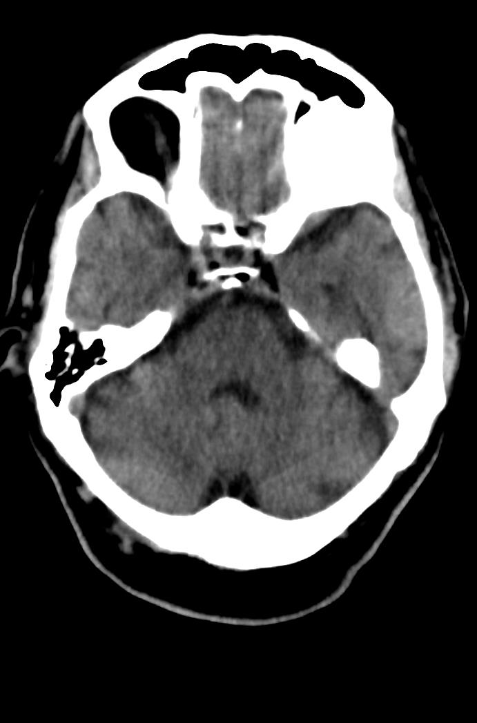 Artery of Percheron infarction (Radiopaedia 80613-94202 Axial non-contrast 62).jpg