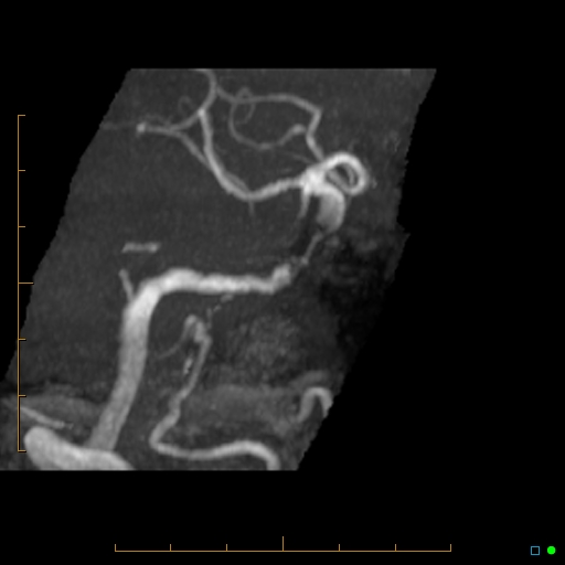 File:Artifactual basilar artery stenosis due to metallic stent (Radiopaedia 31206-31922 3D MIP 8).jpg