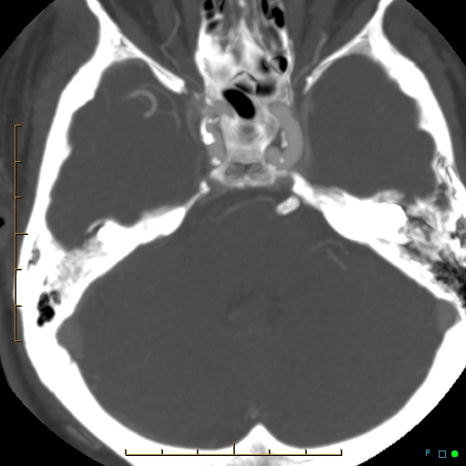 File:Artifactual basilar artery stenosis due to metallic stent (Radiopaedia 31206-31923 A 13).jpg