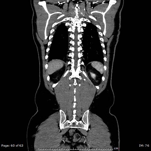 Ascending aortic aneurysm (Radiopaedia 50086-55404 B 60).jpg