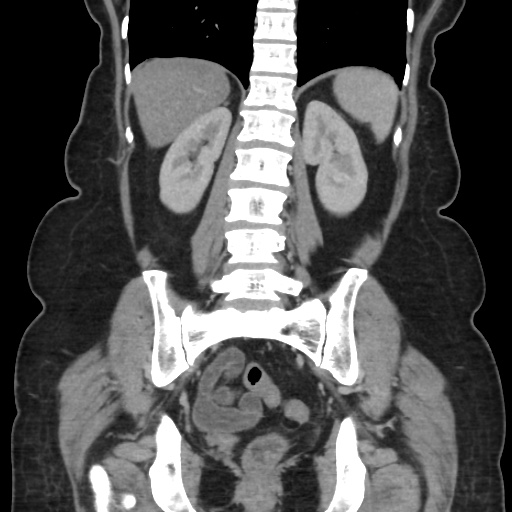 Ascending colon diverticulitis (Radiopaedia 61970-70040 B 45).jpg