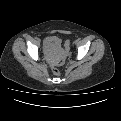 File:Ascending retrocecal appendicitis with liver abscesses (Radiopaedia 60066-67615 Axial non-contrast 76).jpg