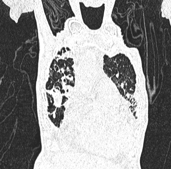 Aspergilloma- with Monod sign (Radiopaedia 44737-48532 Coronal lung window 147).jpg