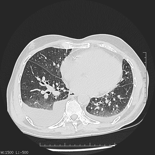Aspergilloma (Radiopaedia 75184-86270 Axial lung window 34).jpg