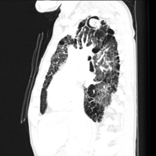File:Aspergilloma (Radiopaedia 8731-9543 Oblique lung window 1).jpg