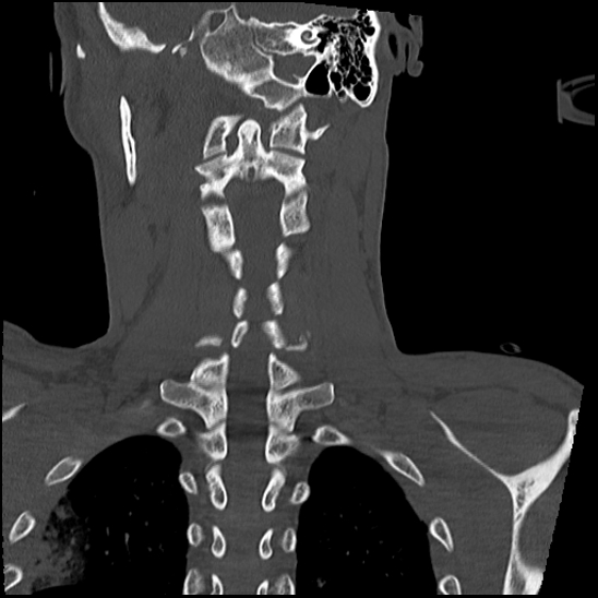 Atlanto-occipital dissociation (Traynelis type 1), C2 teardrop fracture, C6-7 facet joint dislocation (Radiopaedia 87655-104061 Coronal bone window 44).jpg