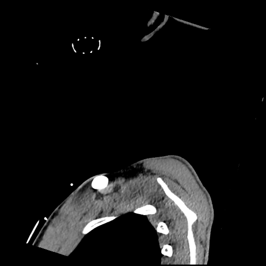 File:Atlanto-occipital dissociation (Traynelis type 1), C2 teardrop fracture, C6-7 facet joint dislocation (Radiopaedia 87655-104061 D 86).jpg
