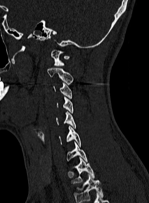 Atlantoaxial subluxation (Radiopaedia 44681-48450 Sagittal bone window 133).jpg