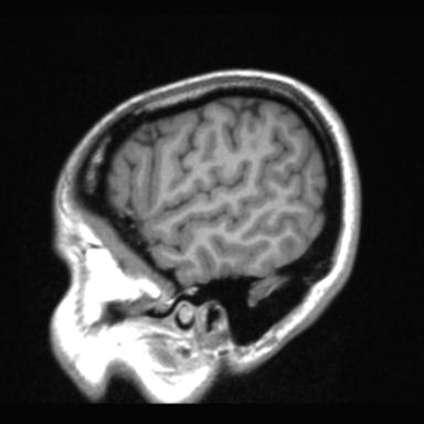 File:Atretic encephalocoele with inferior vermis hypoplasia (Radiopaedia 30443-31108 Sagittal T1 15).jpg