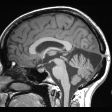 Atretic encephalocoele with inferior vermis hypoplasia (Radiopaedia 30443-31108 Sagittal T1 66).jpg