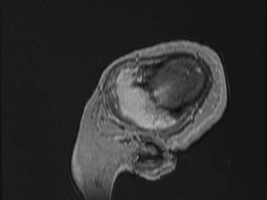 Atypical meningioma (Radiopaedia 62985-71406 Sagittal T1 C+ 99).jpg