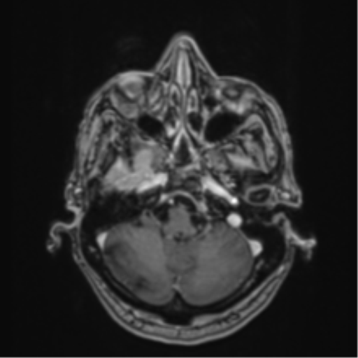 Atypical meningioma (WHO Grade II) (Radiopaedia 54742-60979 Axial T1 C+ 11).png