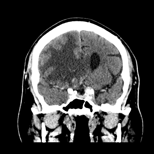 Atypical meningioma (WHO grade II) with brain invasion (Radiopaedia 57767-64728 Coronal C+ 25).png