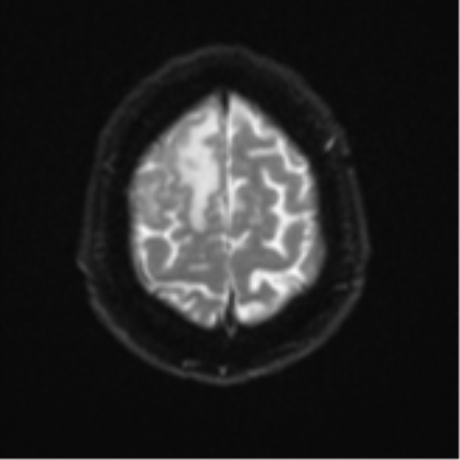 Atypical meningioma (WHO grade II) with brain invasion (Radiopaedia 57767-64729 Axial DWI 26).png