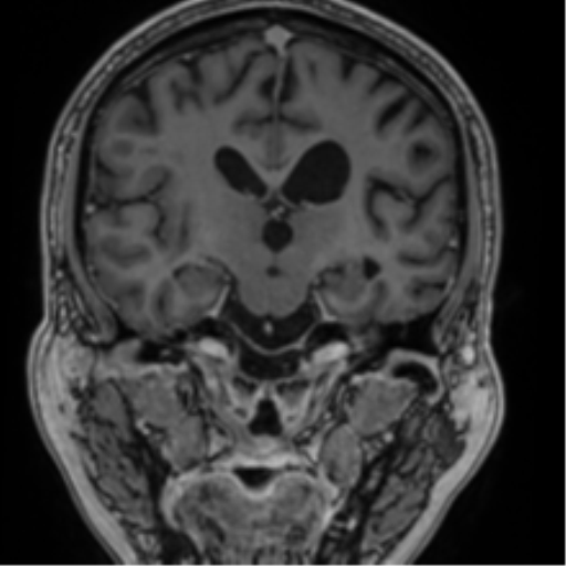 File:Atypical meningioma (WHO grade II) with brain invasion (Radiopaedia 57767-64729 Coronal T1 C+ 45).png