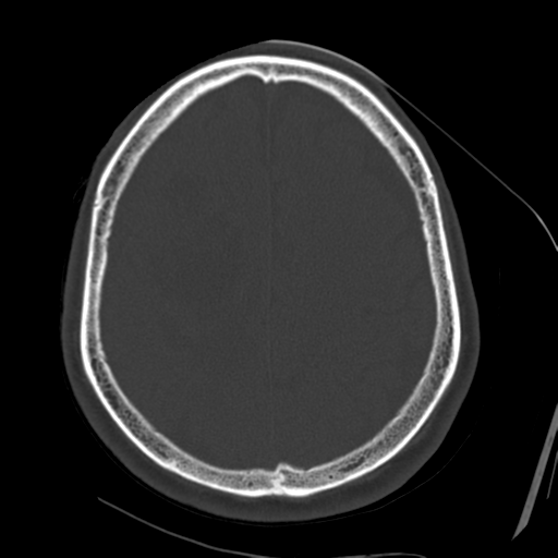 Atypical meningioma (WHO grade II) with osseous invasion (Radiopaedia 53654-59715 Axial bone window 60).png