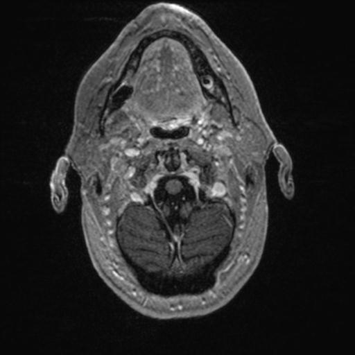 Atypical meningioma (grade II) - en plaque (Radiopaedia 29633-30147 Axial T1 C+ 22).jpg