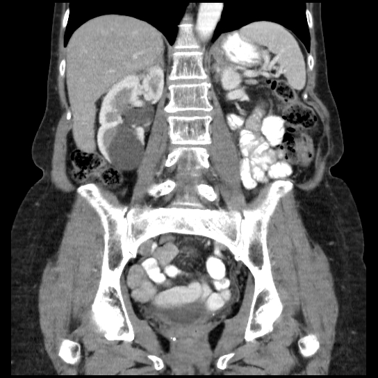 File:Atypical renal cyst (Radiopaedia 17536-17251 C 14).jpg