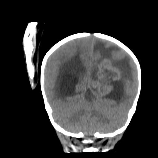 Atypical teratoid rhabdoid tumor (AT-RT) (Radiopaedia 85823-101654 Coronal non-contrast 39).jpg