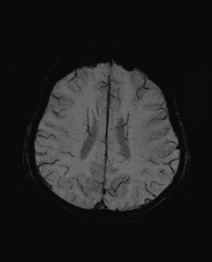 Autoimmune limbic encephalitis (Radiopaedia 30363-31005 SWI - mIP 50).jpg
