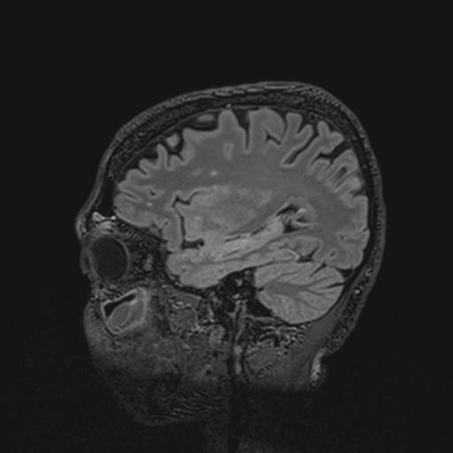 Autoimmune limbic encephalitis (Radiopaedia 30363-31005 Sagittal FLAIR 110).jpg