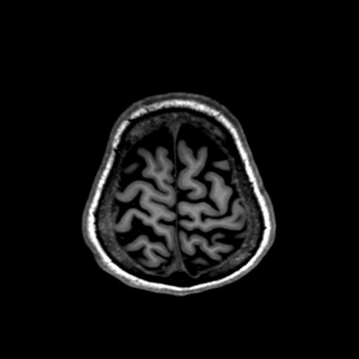 Autoimmune limbic encephalitis (Radiopaedia 30363-31005 T1 Axial 1mm 133).jpg