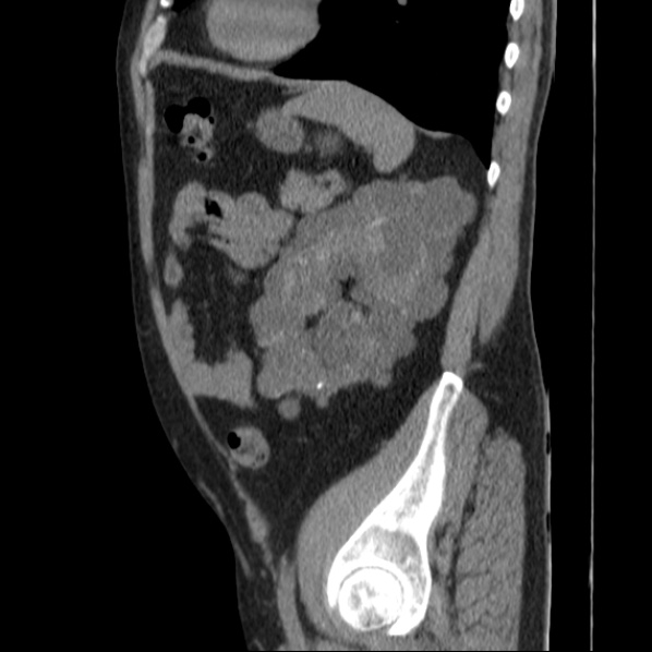 Autosomal dominant polycystic kidney disease (Radiopaedia 36539-38101 D 61).jpg
