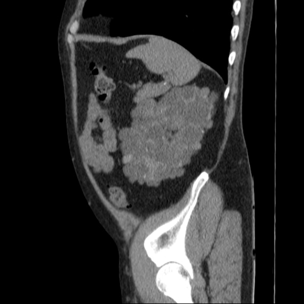 Autosomal dominant polycystic kidney disease (Radiopaedia 36539-38101 D 66).jpg