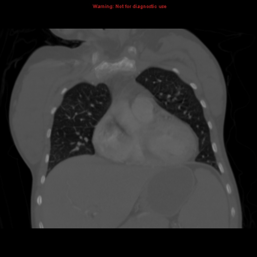 Avascular necrosis in sickle cell disease (Radiopaedia 17448-17152 Coronal bone window 41).jpg