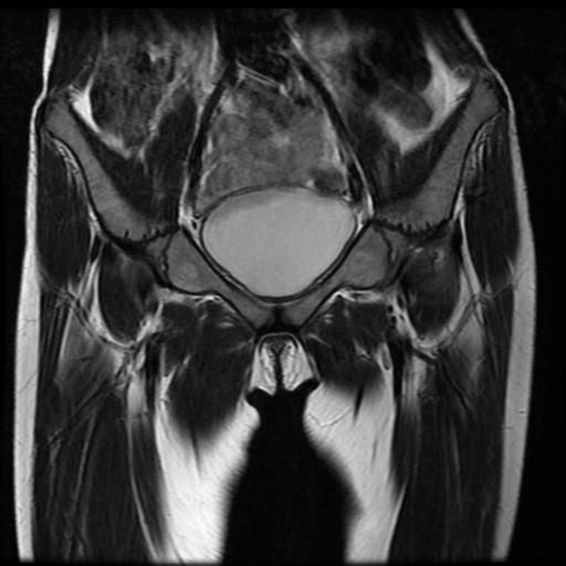 File:Avascular necrosis of the hip (Radiopaedia 29563-30067 Coronal T2 3).jpg