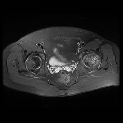 File:Avascular necrosis of the hip (Radiopaedia 61503-69465 Axial PD fat sat 15).jpg