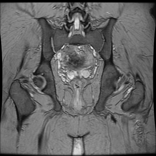 Avascular necrosis of the hip (Radiopaedia 61503-69465 F 69).jpg