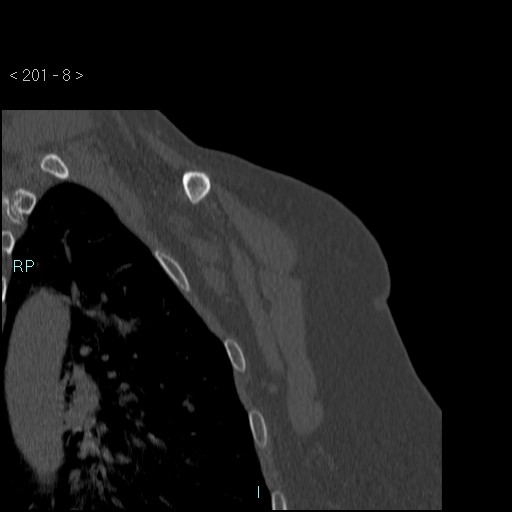 Avascular necrosis of the shoulder - Cruess stage I (Radiopaedia 77674-89887 Coronal bone window 7).jpg