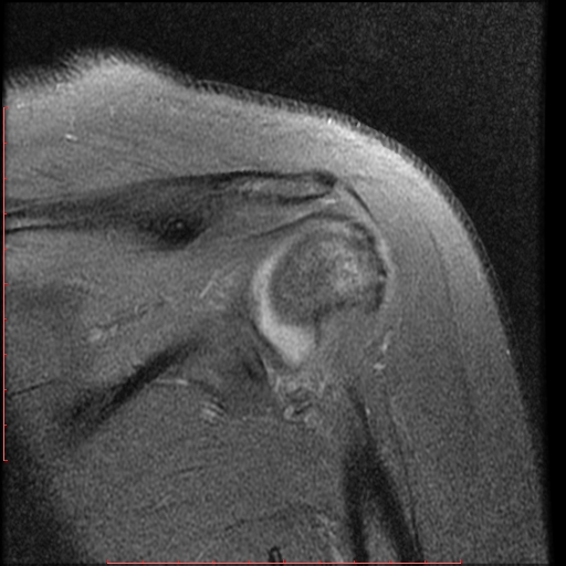 File:Avulsion fracture - greater tuberosity of humerus (Radiopaedia 25457-25703 Coronal PD 10).jpg