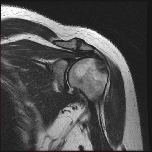 File:Avulsion fracture - greater tuberosity of humerus (Radiopaedia 25457-25703 Coronal T2 6).jpg