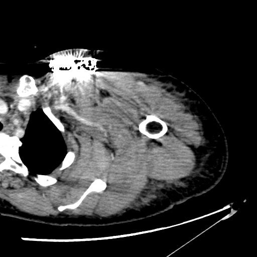 File:Axillary arterial pseudoaneurysm (Radiopaedia 24925-25195 A 6).jpg