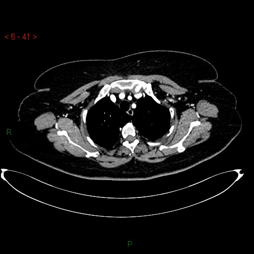 File:Azygos fissure and lobe (Radiopaedia 47620-52278 A 27).jpg