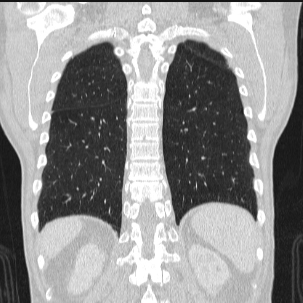 Azygos lobe (Radiopaedia 38259-40275 Coronal lung window 62).jpg