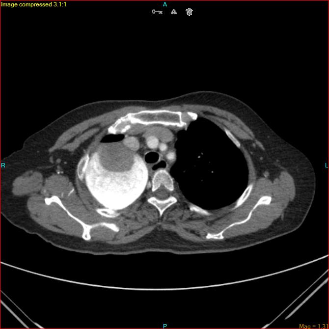 Azygos vein aneurysm (Radiopaedia 77824-90130 B 15).jpg