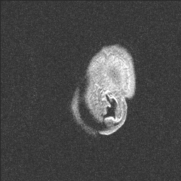 Balo concentric sclerosis (Radiopaedia 50458-55940 Sagittal T1 11).jpg