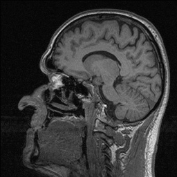 File:Balo concentric sclerosis (Radiopaedia 50458-55940 Sagittal T1 92).jpg