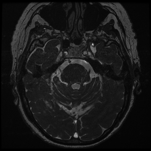 File:Balo concentric sclerosis (Radiopaedia 53875-59982 Axial T2 FIESTA 54).jpg
