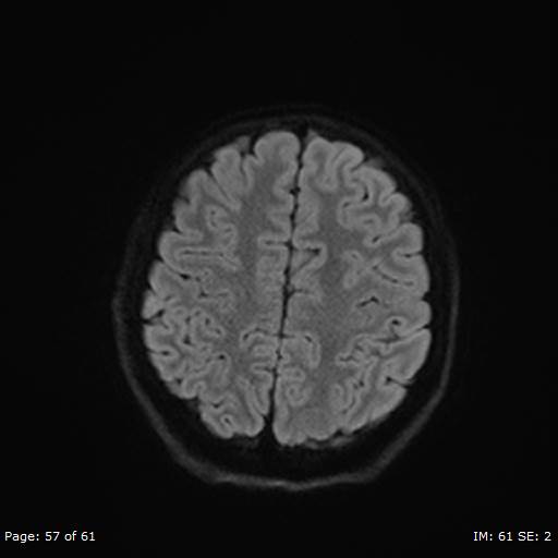 Balo concentric sclerosis (Radiopaedia 61637-69636 Axial DWI 57).jpg