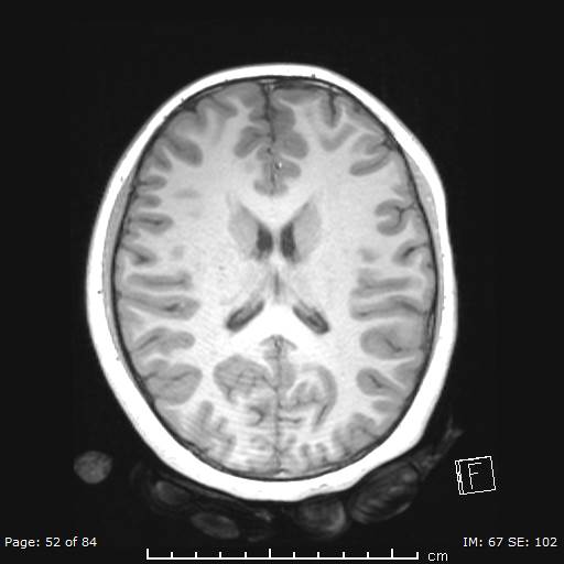 Balo concentric sclerosis (Radiopaedia 61637-69636 Axial T1 52).jpg