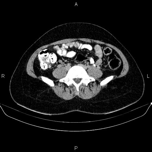 Bartholin gland cyst (Radiopaedia 62635-70930 C 3).jpg
