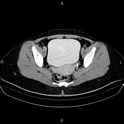 Bartholin gland cyst (Radiopaedia 62635-70930 C 50).jpg