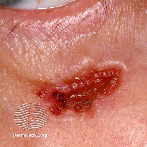 File:Basal cell carcinoma affecting the face (DermNet NZ lesions-bcc-face-0638).jpg