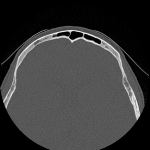 File:Base of skull chondrosarcoma (Radiopaedia 30410-31071 Axial bone window 42).jpg
